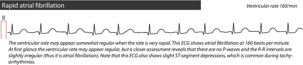 Figure 3. Rapid atrial fibrillation.