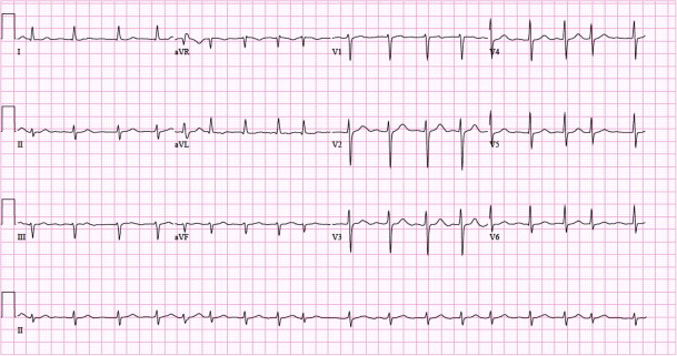 Atrial Fibrillation Ecg Classification Causes Risk Factors