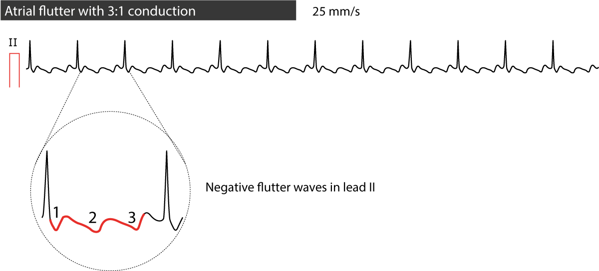 Figura 2. Flutter atriale condotto 3:1.