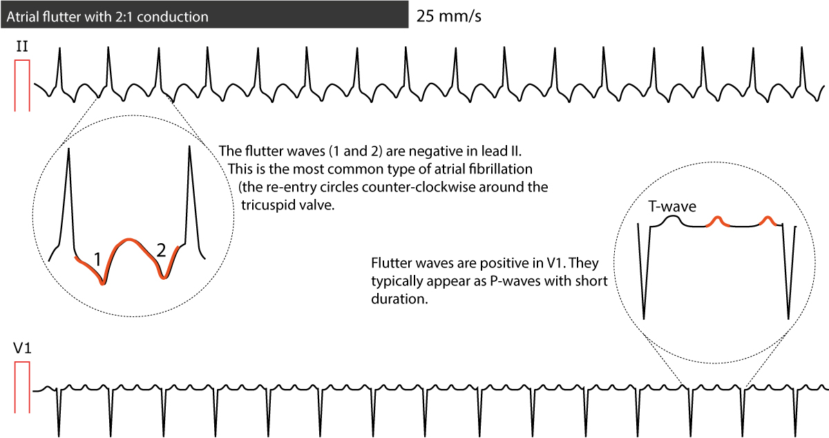 Figure 1. Flutter atrial típico.