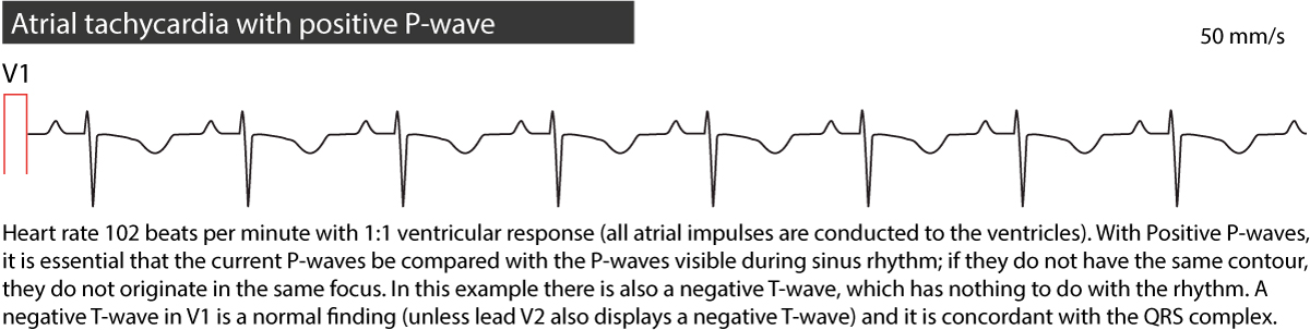 ectopic atrial tach