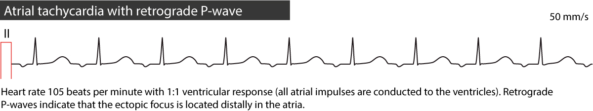 ectopic atrial tach