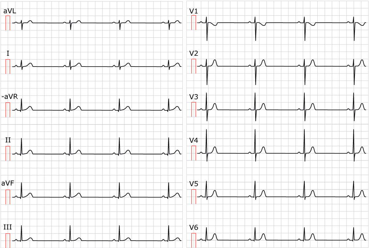 heart rhythm bradycardia