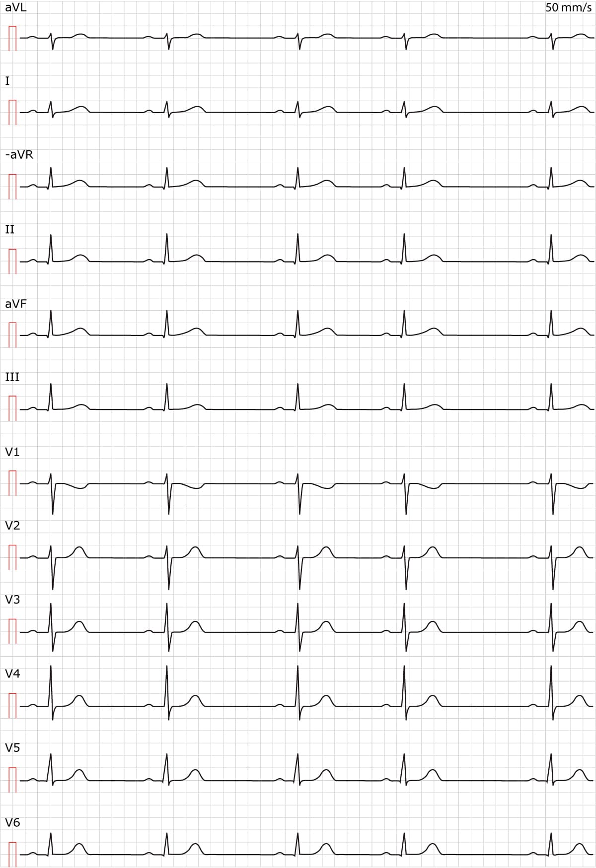 sinus arrhythmia rhythm strip