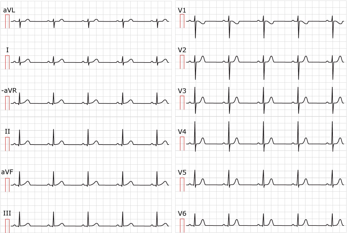 Sinus Rhythm Physiology Ecg Criteria Clinical Implications Ecg Echo