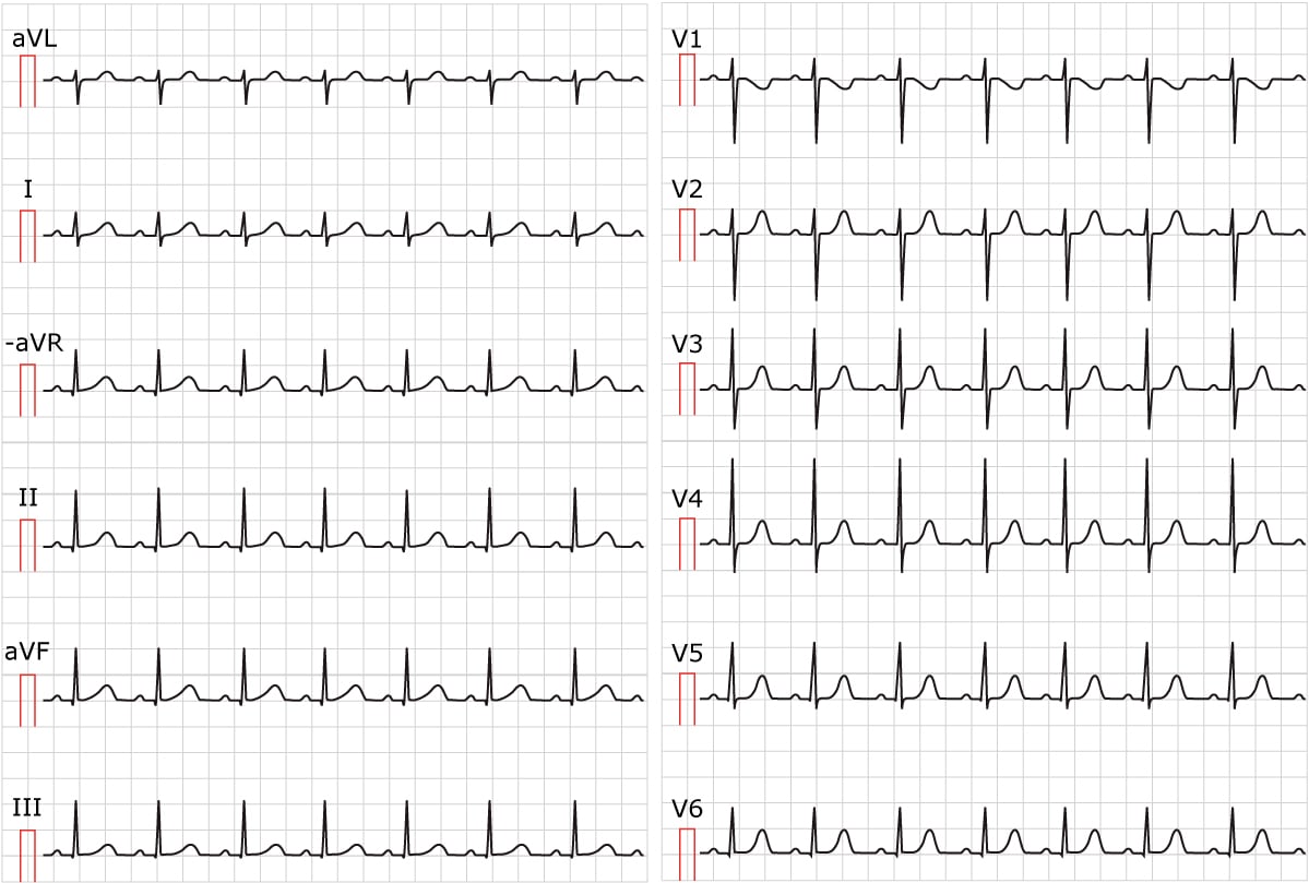 Figure 1. ECG showing sinus tachycardia. Paper speed 25 mm/s. Calculate the heart rate by dividing 300 by the number of large boxes between R-waves. There are approximately 3 large boxes between the R-waves; 300/3 equals 100 beats per minute.