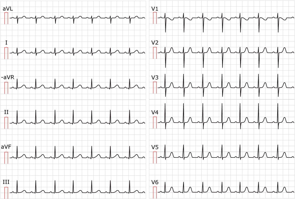 Sinus tachycardia and inappropriate sinus tachycardia