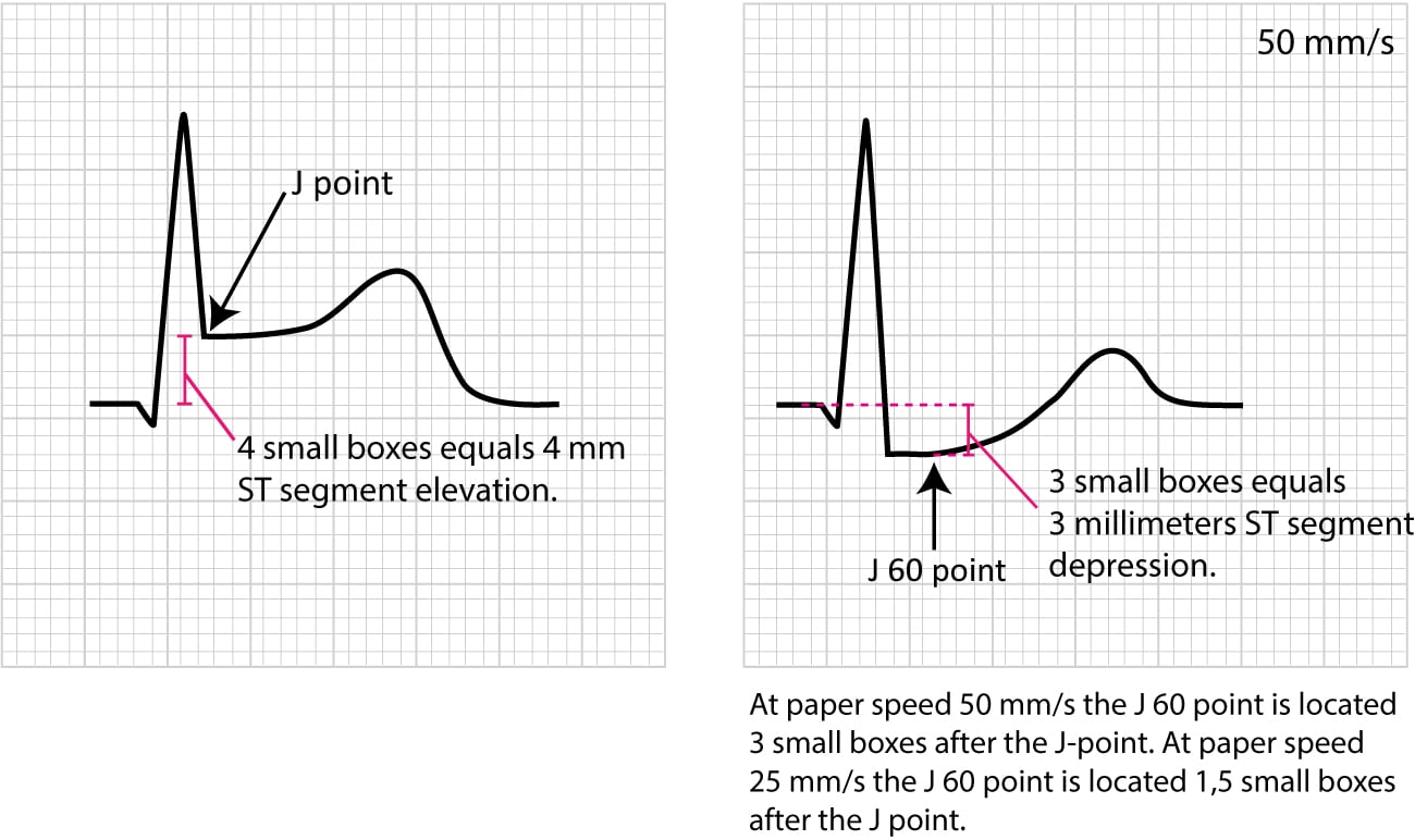 Figure 14. Example of measuring STdeviation. ECG learning