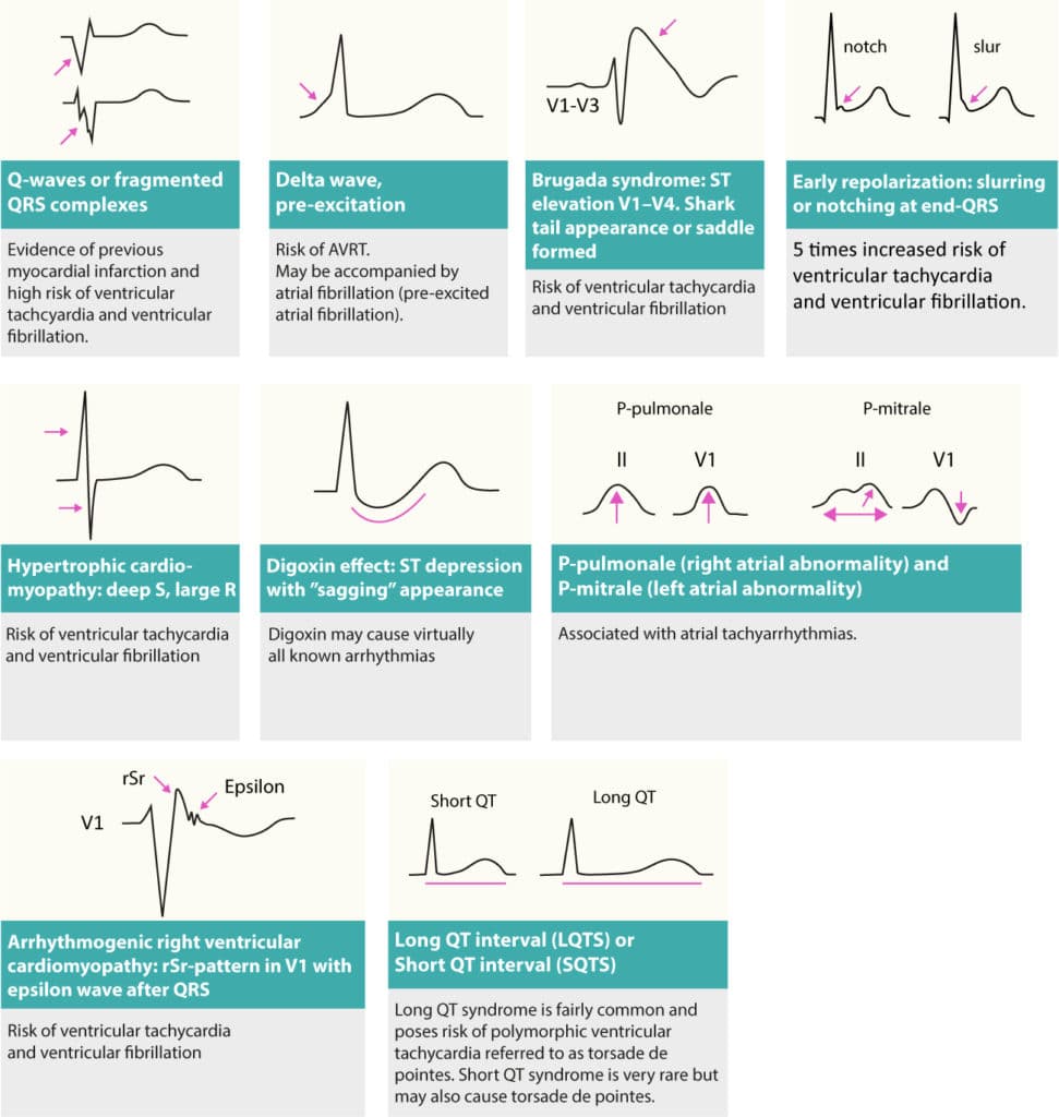 Figure 3. Changes on resting ECG that may reveal cause of arrhythmias (arrhythmia substrates). Patients presenting with tachycardia (tachyarrhythmia) may display any of these on their resting ECG.