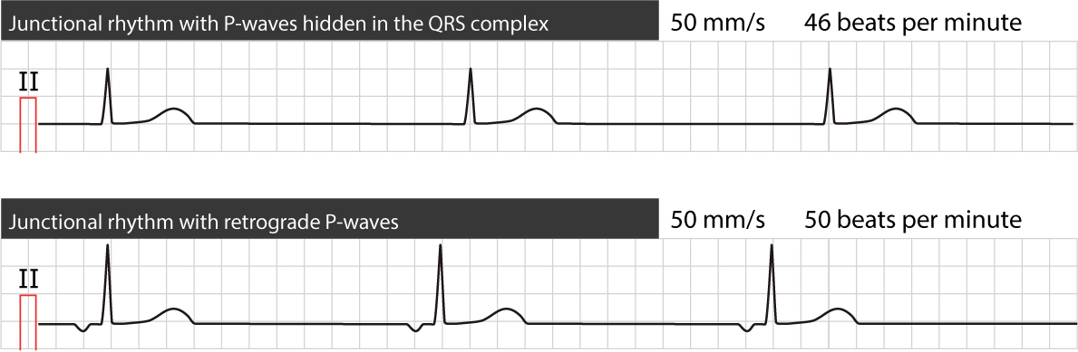 Figure 1. Two types of junctional (escape) rhythm.