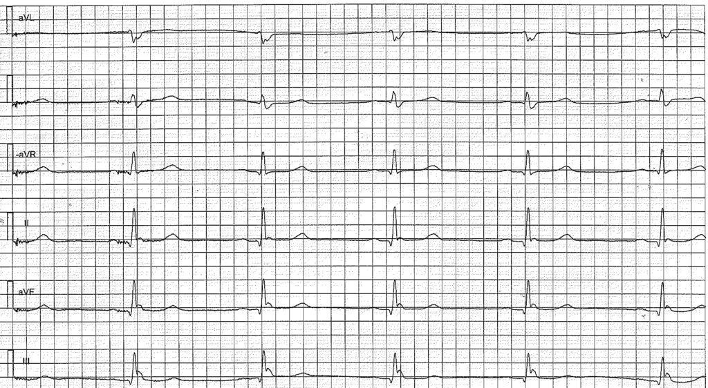 Figure 3. Osborn wave (J wave) in patient with early repolarization.