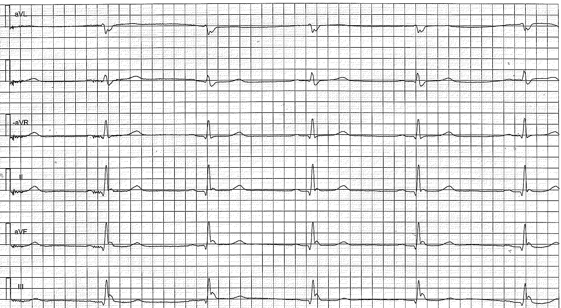 Figure 2. Limb leads showing early repolarization. This patients brother died from sudden cardiac arrest at the age of 29.