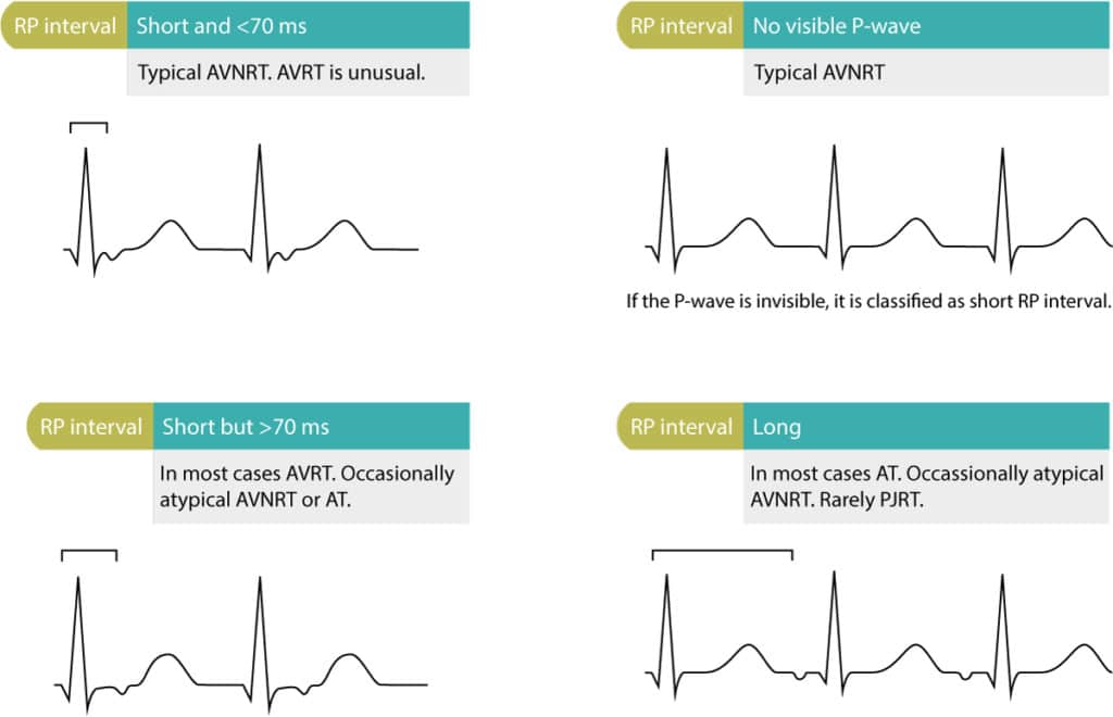 Figure 2. Differential diagnoses based on RP interval. The RP interval must be assessed in any tachycardia (tachyarrhythmia) with visible P waves.