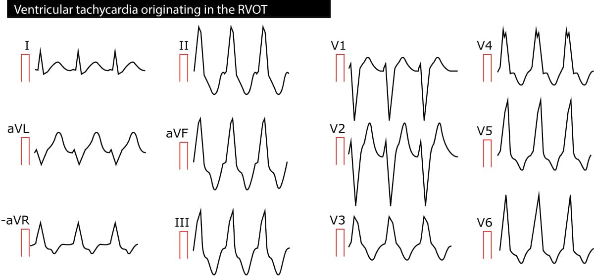 Figure 2. Ventricular tachycardia originating in the right ventricular