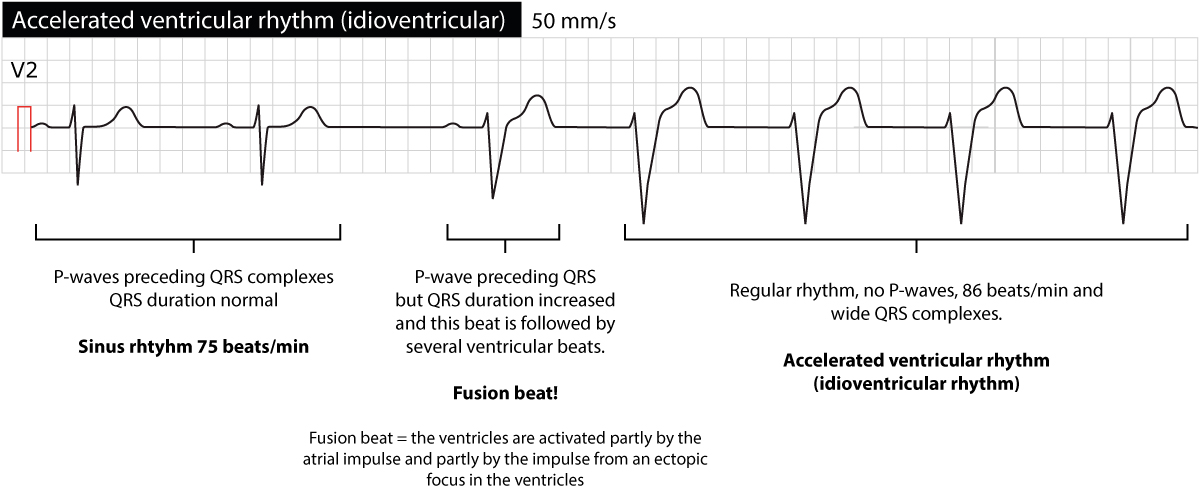 Figure 2. Idioventricular rhythm (accelerated ventricular rhythm).