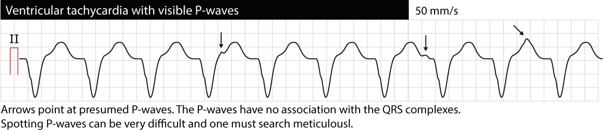 Diagnosis and management of ventricular tachycardia (VT): from ECG to treatment
