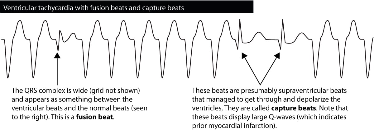 Figure 6. Capture beats and fusion beats in ventricular tachycardia ...