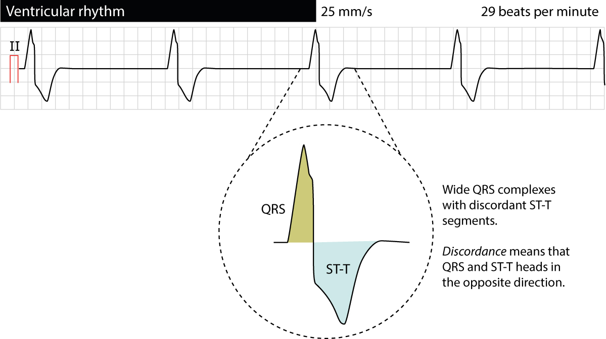 ventricular escape rhythm