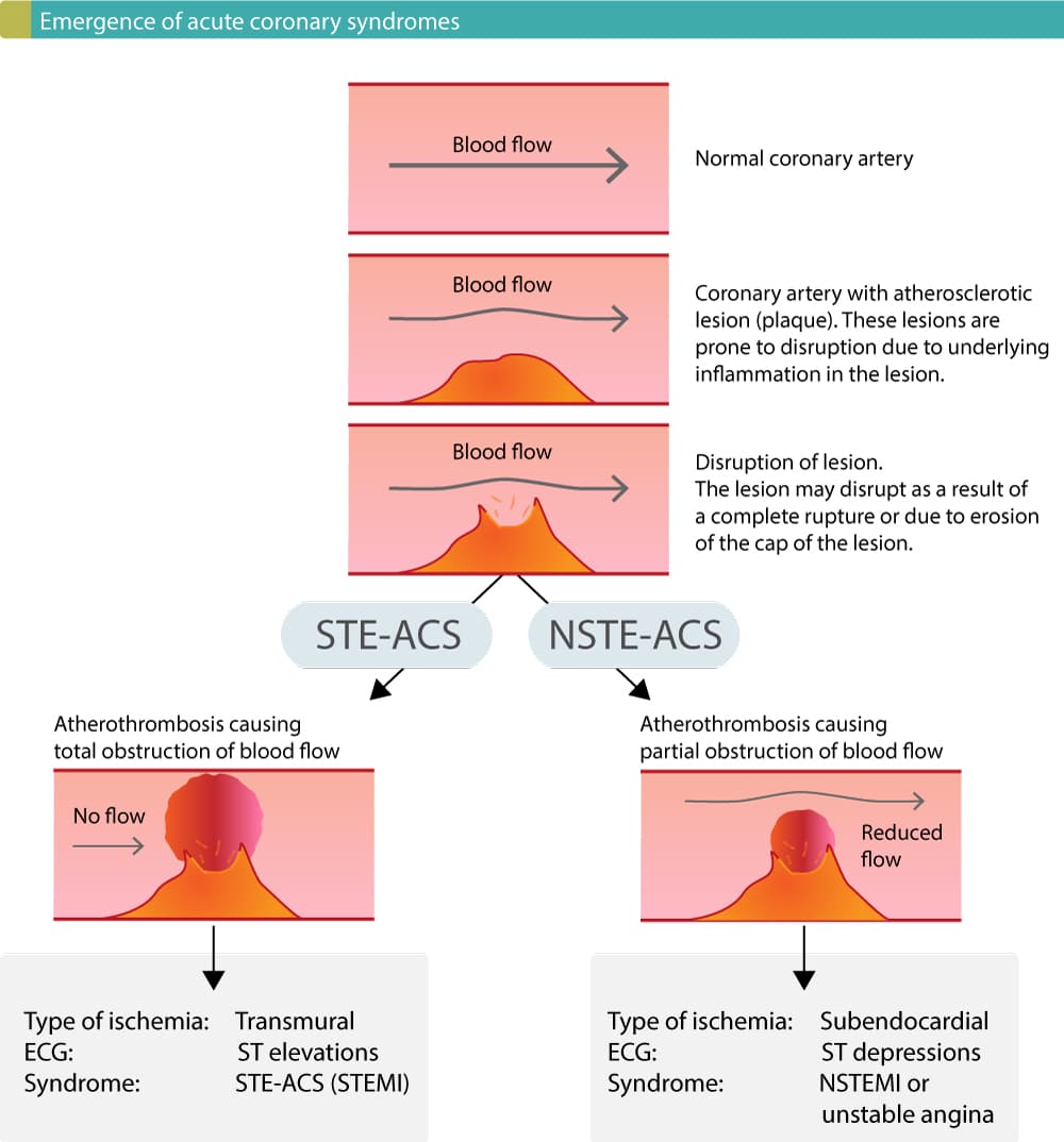 classification-of-acute-coronary-syndromes-acs-acute-myocardial