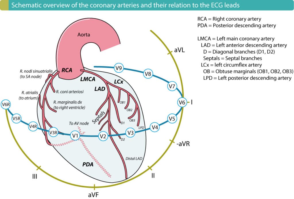 The right ventricle is supplied by the right marginal artery (r. marginalis dx), which originates from the right coronary artery (RCA). The RCA also supplies the inferior left ventricular wall in over 90% of all individuals. Hence, a proximal occlusion (in the RCA) which cuts off blood flow to the right ventricle, will also affect the inferior wall of the left ventricle in 90% of the cases.