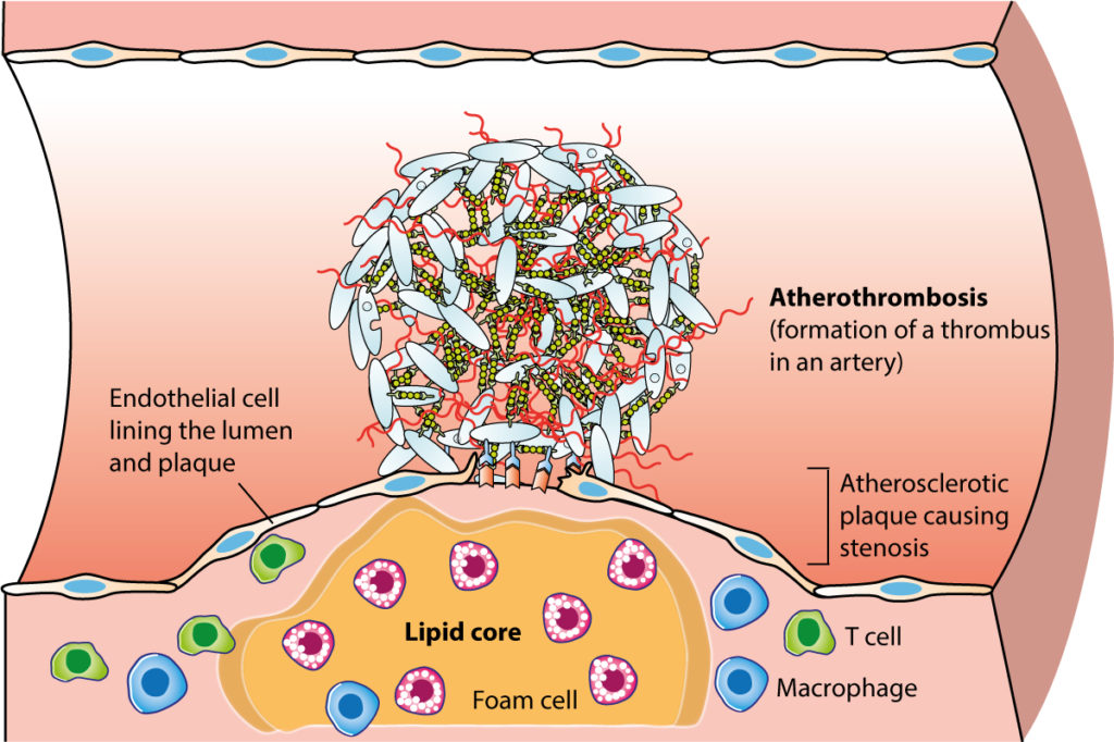 Figure 1. Atherosclerotic plaque which has ruptured and lead to atherothrombosis.