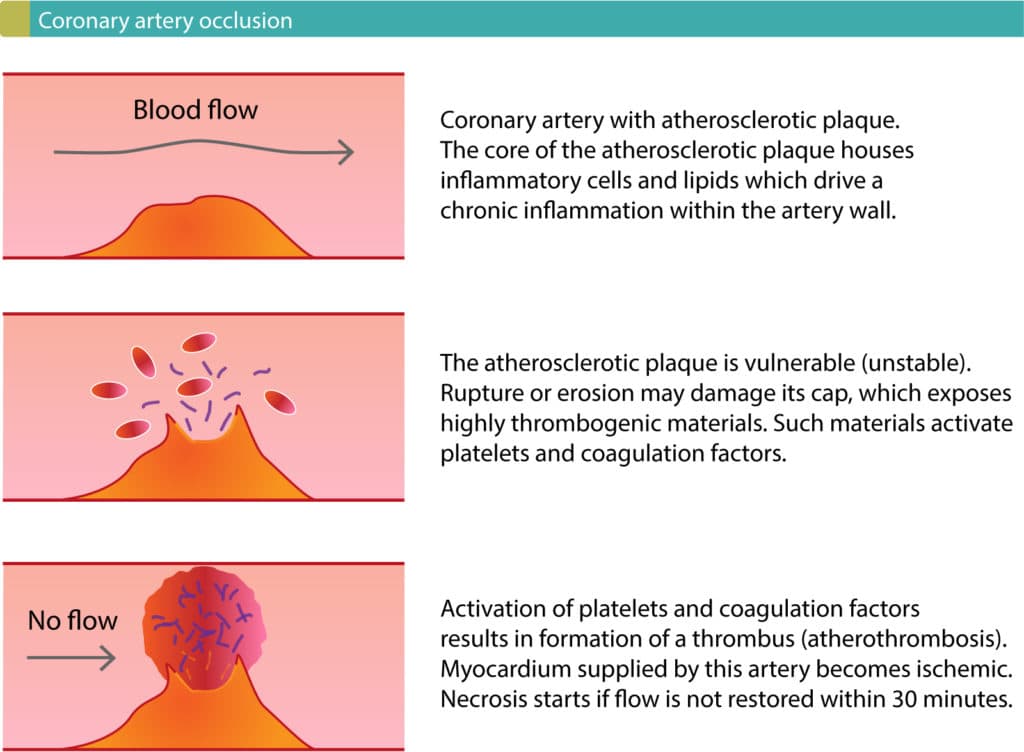 Figure 1. Acute myocardial infarction is usually initiated by rupture or erosion of a vulnerable (unstable) atherosclerotic coronary plaque.