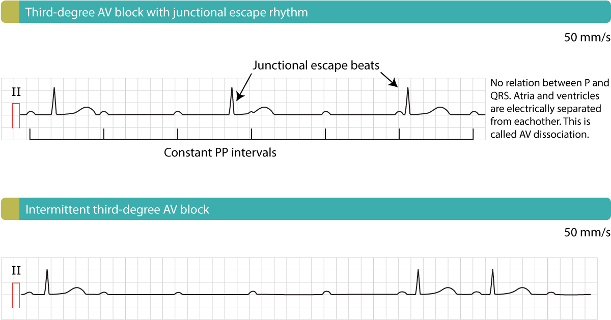 Unusual presentation of STEMI : Mobitz type 2 AV block