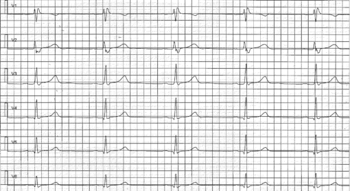 Early repolarization pattern on ECG (early repolarization syndrome ...