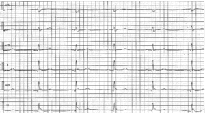 Early repolarization pattern on ECG (early repolarization syndrome ...