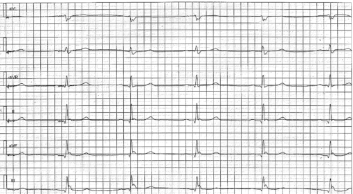 Early repolarization pattern on ECG (early repolarization syndrome ...