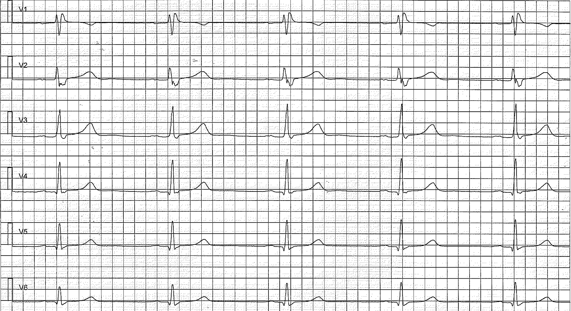 repolarization ecg