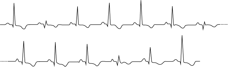 Figure 1. Electrical alternans in patient with cardiac tamponade. The ECG shows varying QRS and T-wave amplitudes.