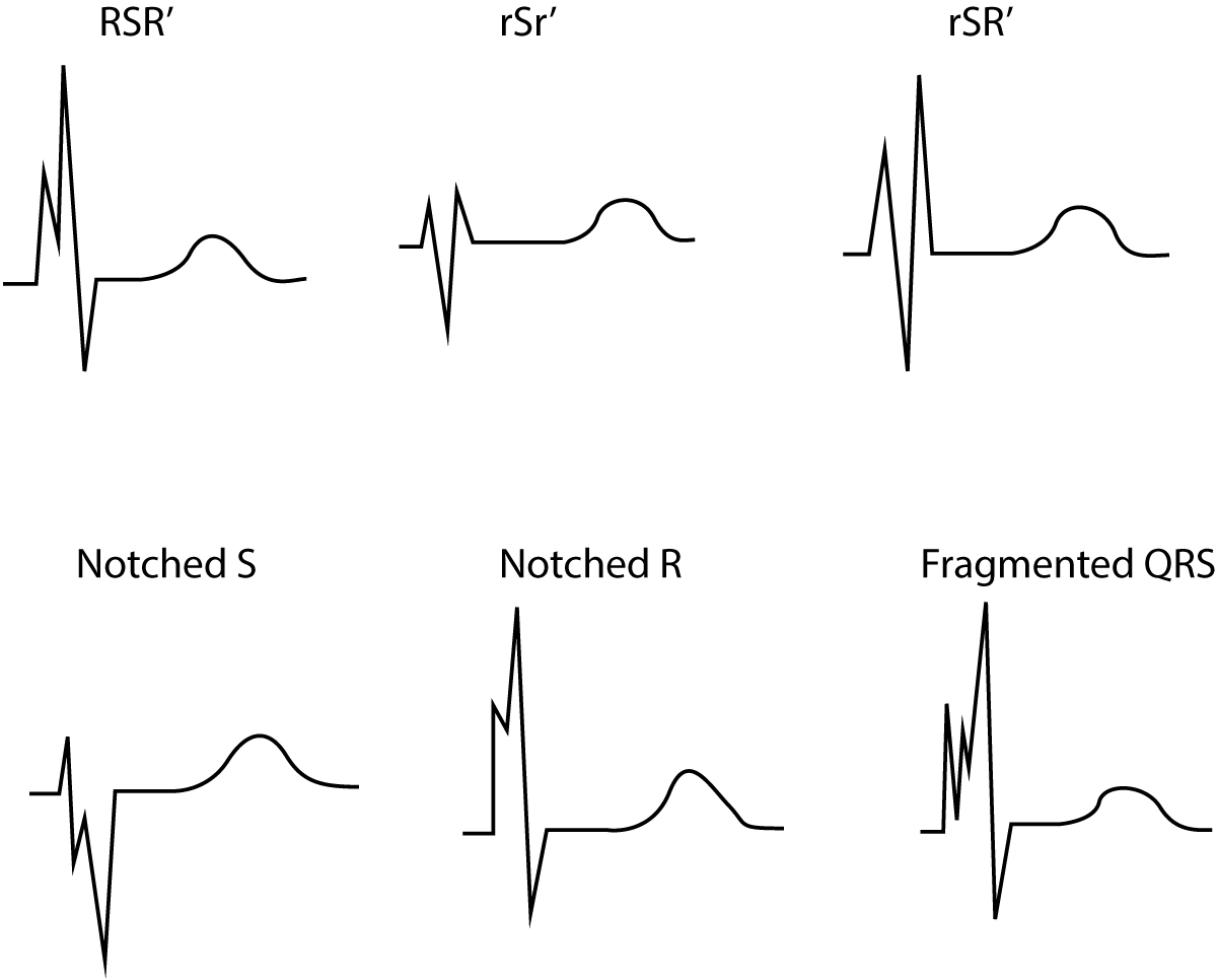 Figure 2. Fragmented QRS complex. These QRS configurations are also indicate of previous myocardial infarction.