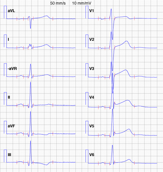 Figure 4. Osborn wave (J wave) in patient with early repolarization. This patient was 31 years old when she died from sudden cardiac death.