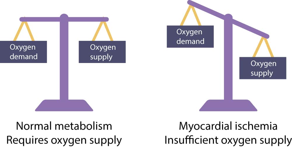 Figure 1. Myocardial cells require continues oxygen supply in order to maintain normal metabolism. If oxygen supply is less than oxygen demand, ischemia developes. Myocardial cells can switch to anaerobic metabolism and discontinue contractions in order to alleviate the ischemia. This enables the cell to endure up to 30 minutes of severe ischemia. If blood flow is not restored before 30 minutes, the cell will die. Death of myocardial cells is referred to as myocardial infarction.