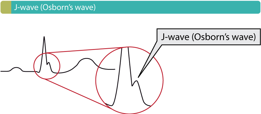 ECG J wave syndromes: hypothermia, early repolarization, hypercalcemia ...