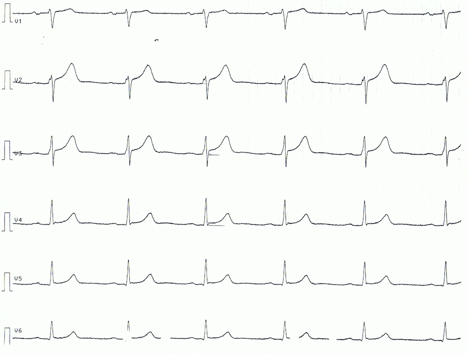 Figura 3. Derivaciones torácicas de un paciente con pericarditis aguda. Obsérvense las elevaciones del segmento ST, segmentos ST cóncavos.