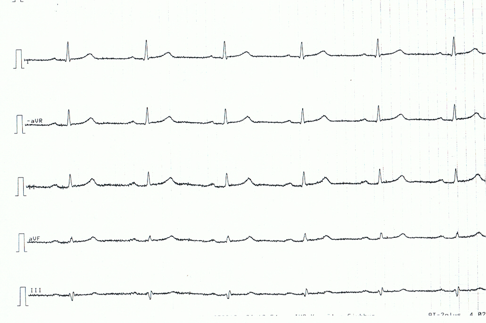 Figura 4. Derivaciones de las extremidades de un paciente con pericarditis aguda. Obsérvense las elevaciones muy discretas, pero generalizadas, del segmento ST, segmentos ST cóncavos.