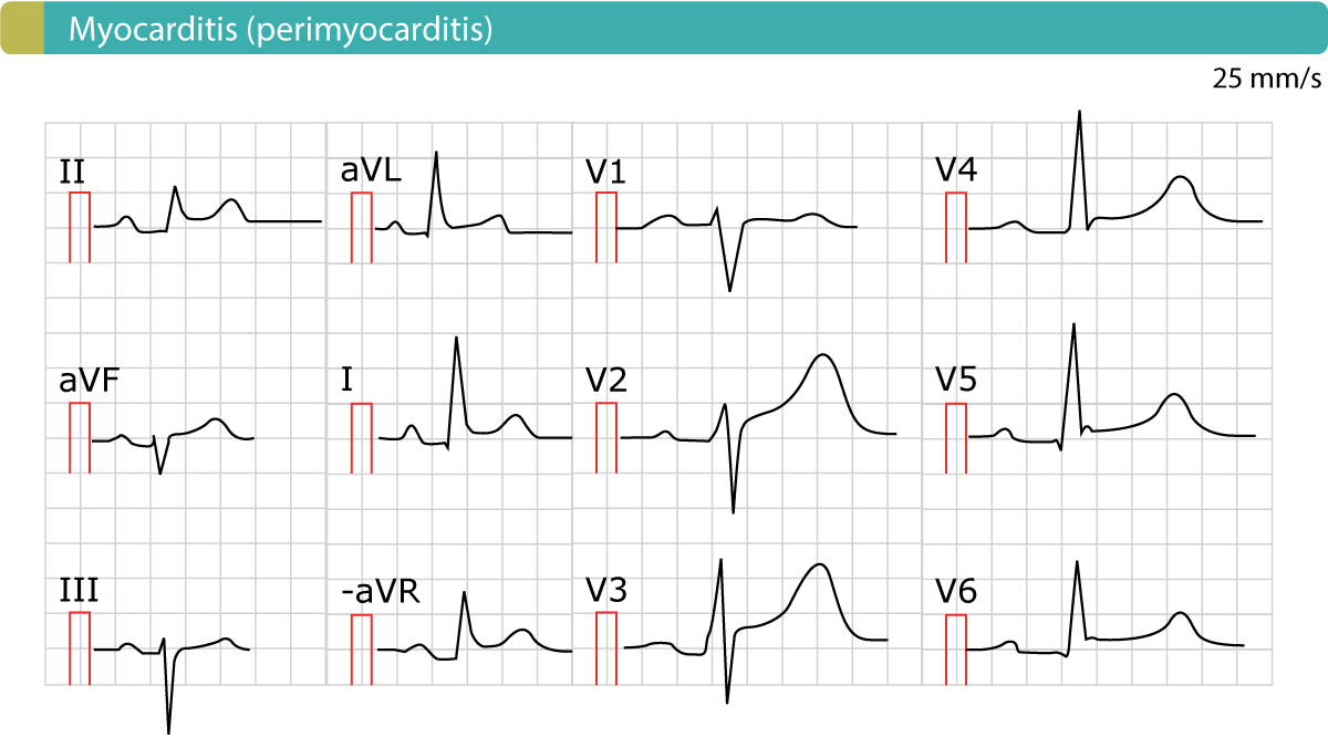 Kuva 2. EKG akuutissa perikardiitissa (myokardiitti, perimyokardiitti). Kuten ilmeistä on yleistyneet ST-segmentin kohoumat. Vastavuoroisia ST-segmentin depressioita ja samanaikaisia T-aaltoinversioita (negatiivisia T-aaltoja) ei ole.