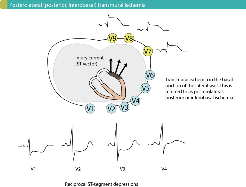 Figure 1. Posterolateral (posterior, inferobasal) transmural ischemia causes reciprocal ST-segment depressions in V1–V3 (ocasionally V4). Leads V7–V9 must be placed to reveal the ST-segment elevations.