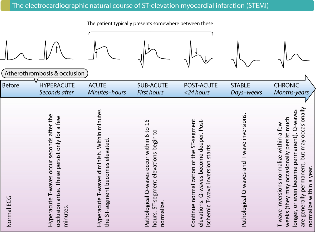 Figure 2. The electrocardiographic natural course in STEMI (ST elevation myocardial infarction).