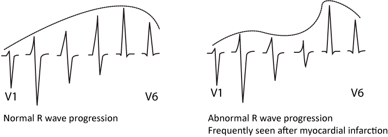 Figure 1. Pathological R-wave progression is indicative of previous myocardial infarction.