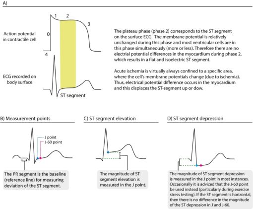 ECG In Myocardial Ischemia Ischemic Changes In The ST Segment T wave 