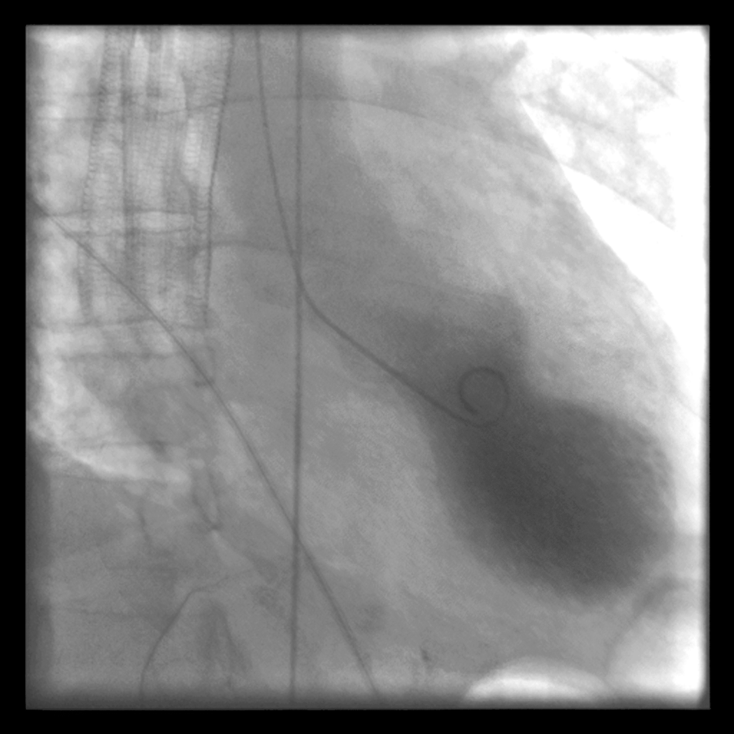 Figure 2. Left ventriculography during systole showing apical ballooning akinesis with basal hyperkinesis in a characteristic takotsubo ventricle.