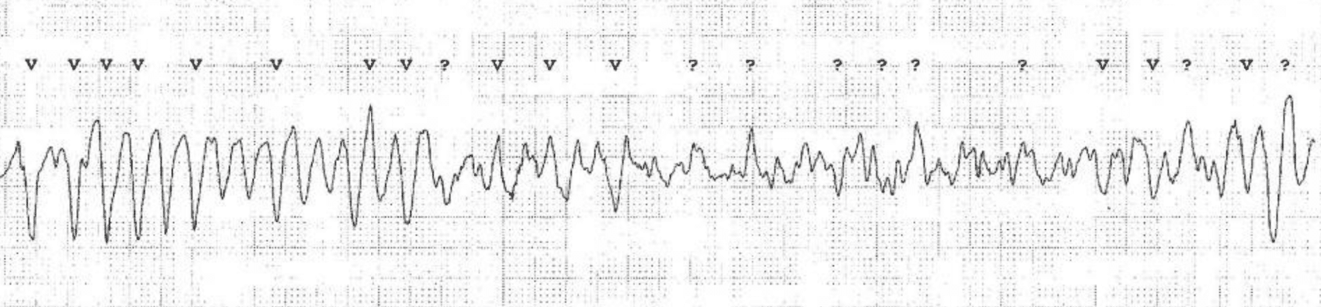 Long QT (QTc) interval, long QT syndrome (LQTS) & torsades de pointes ...