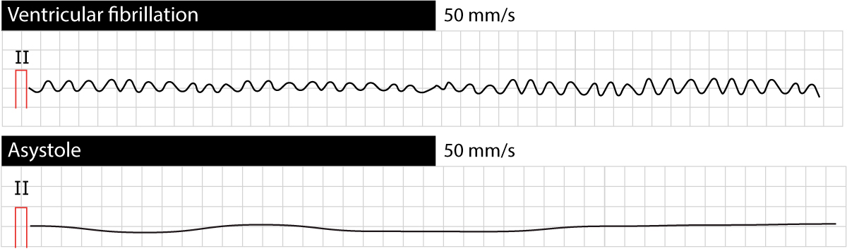 ventricular fibrillation vs atrial fibrillation