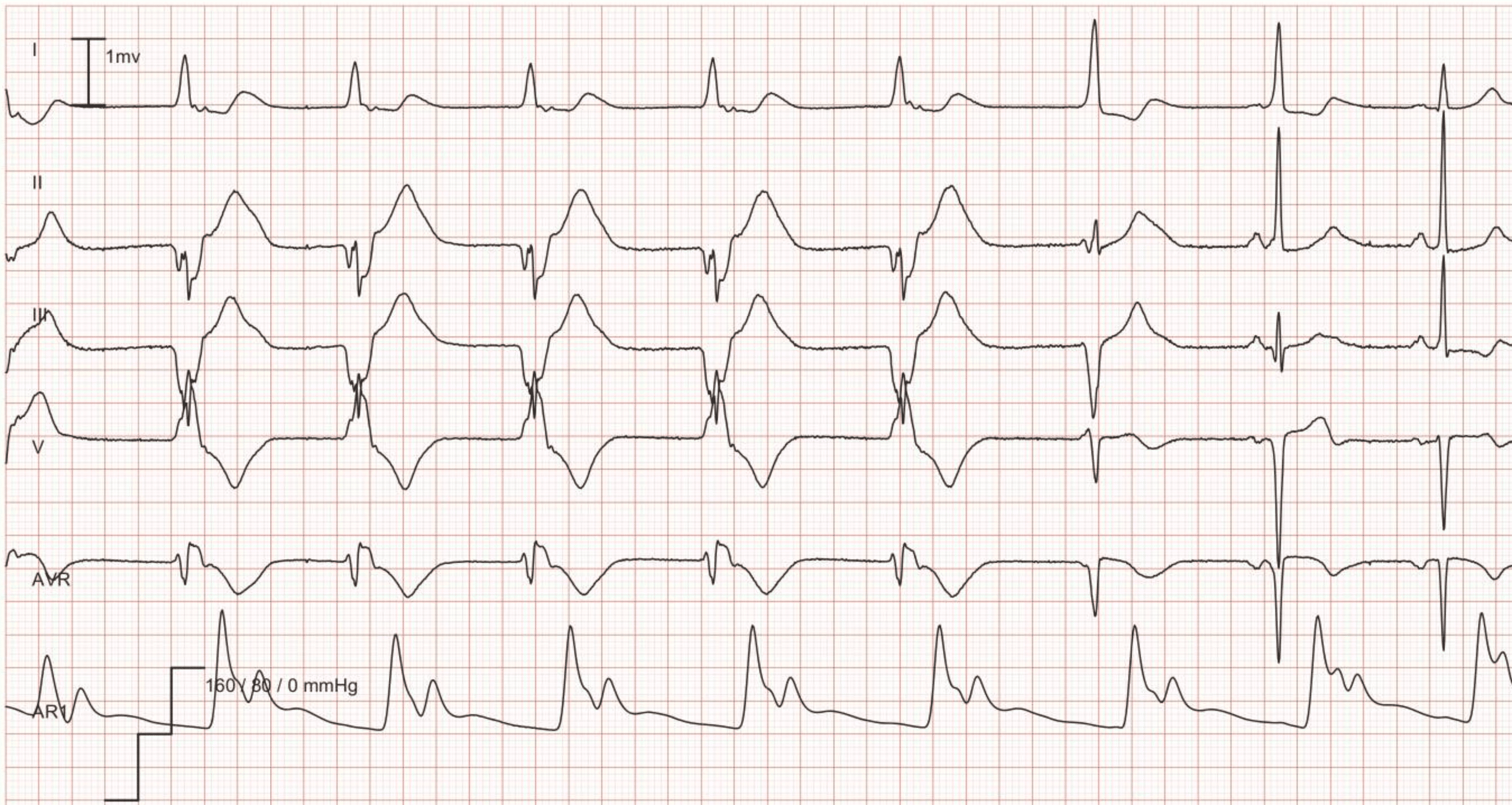 atropine on junctional escape rhythm