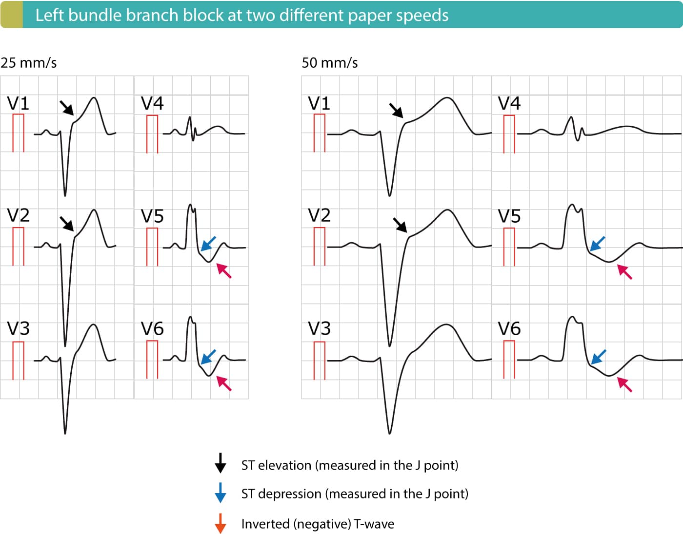 Left Bundle Branch Block Ecg