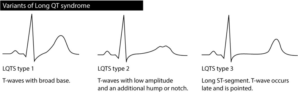 Long QT (QTc) interval, long QT syndrome (LQTS) & torsades de pointes ...