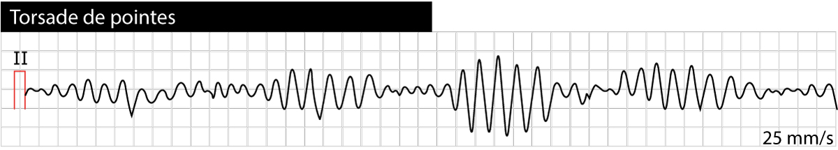 Long QT (QTc) interval, long QT syndrome (LQTS) & torsades de pointes ...